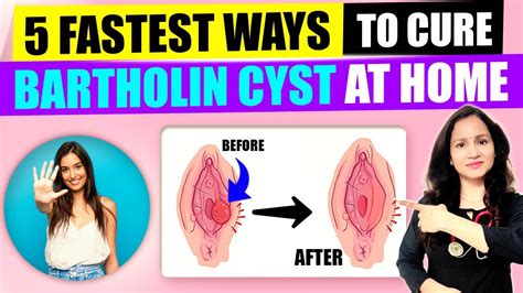 10 Bartholin Cyst Removal Tips For Easy Recovery