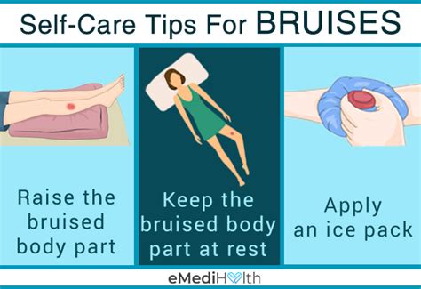 10 Bruise Prevention Tips