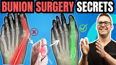 10+ Bunion Surgery Secrets For A Smoother Recovery