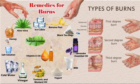 10 Burn Remedies For 2Rd Degree Burn Relief