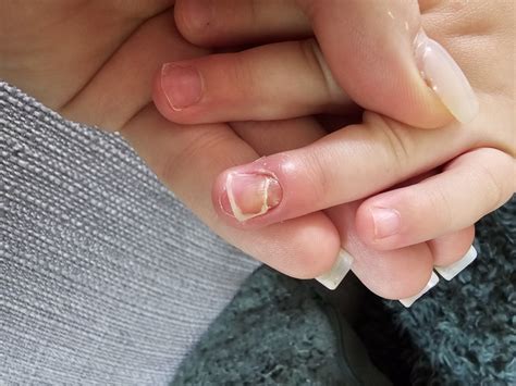10+ Causes Of Nail Falling Off To Know Immediately