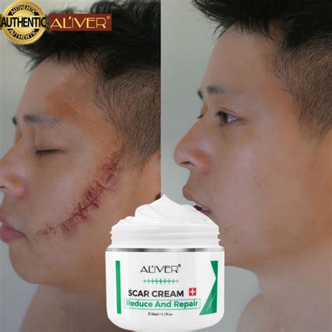 10+ Face Burn Treatments To Reduce Scarring