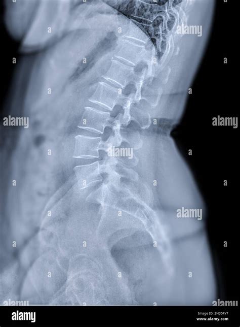 10+ Lumbar Spine X Ray Secrets For Better Results