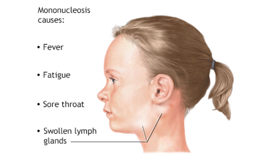 10 Lymph Node Swelling Fixes For Quick Relief