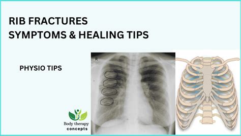 10 Rib Treatment Tips For Faster Healing