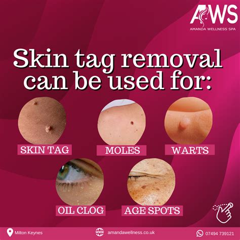 10 Skin Tag Removal Prices That Save Money