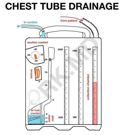 10 Thoracic Drainage Tube Tips For Faster Recovery