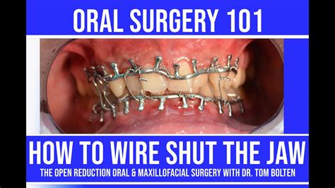 10+ Ways To Eat With Jaw Wired Shut Easily