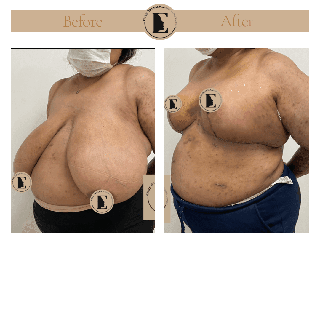 12 Boob Reduction Tips For A Lifted Look