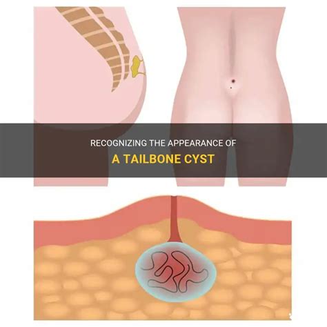 12+ Cyst On Tailbone Tips For Easy Recovery