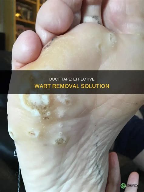 12 Duct Tape Wart Remedies That Work Fast