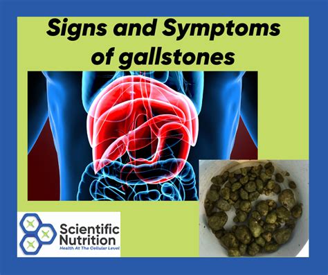 12 Gallstones Symptoms To Expect