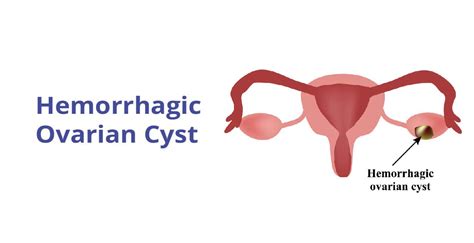 12 Hemorrhagic Ovarian Cyst Symptoms To Recognize