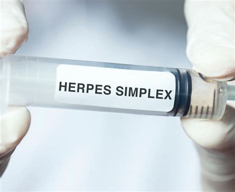 12 Herpes Testing Tips For Accurate Results