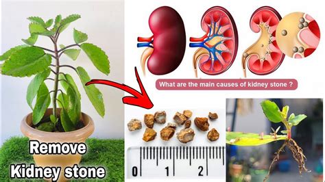 12 Lone Tree Kidney Remedies That Work