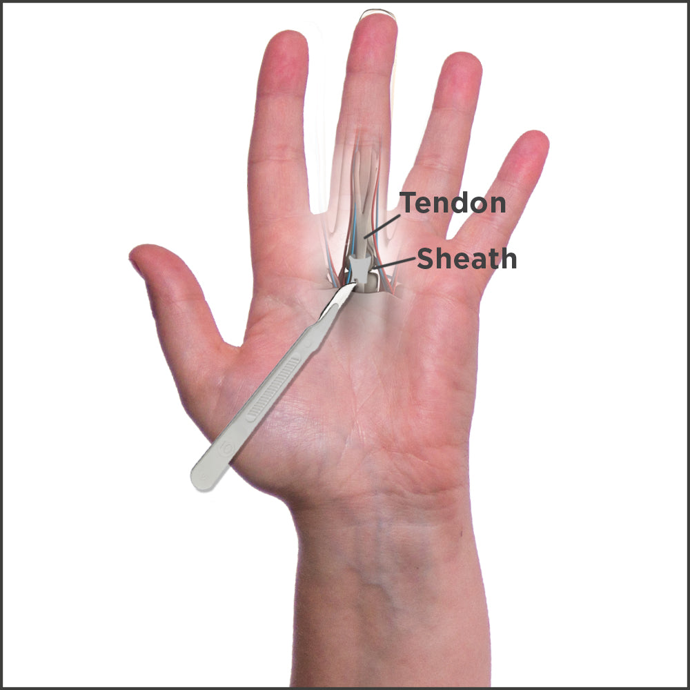 12+ Trigger Thumb Surgery Secrets For Less Pain
