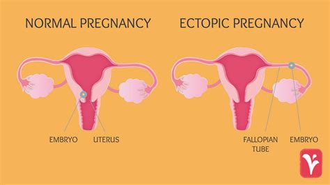 12 Tubal Ectopic Pregnancy Symptoms To Recognize