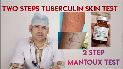 2 Step Tb Test