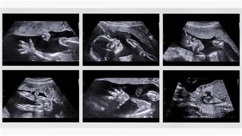 20 Week Ultrasound: Comprehensive Guide Inside