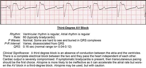 3Rd Degree Av Block Treatment