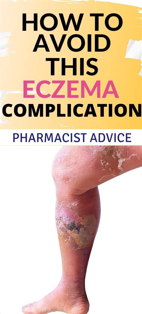 7 Eczema Creams With Hydrocortisone For Fast Healing
