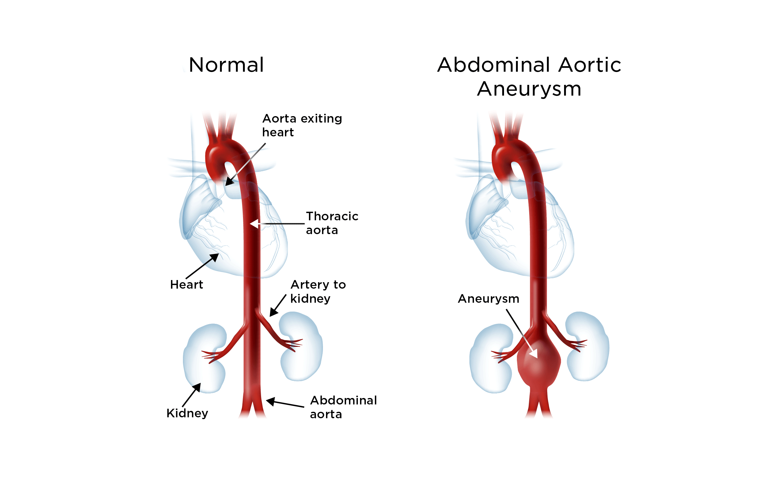 Abdominal Aortic Aneurysm Surgery