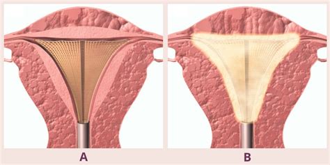 Ablation Of The Uterus