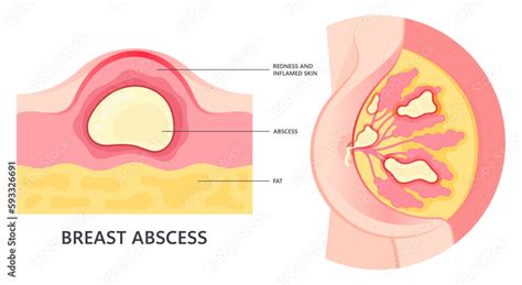 Abscess On Boob