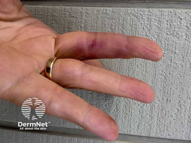 Achenbach S Syndrome A Recognized Genetic Link Vhrm Achenbach S Syndrome A Recognized Genetic Link Vhrm
