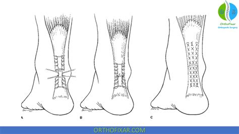 Achilles Tendon Repair