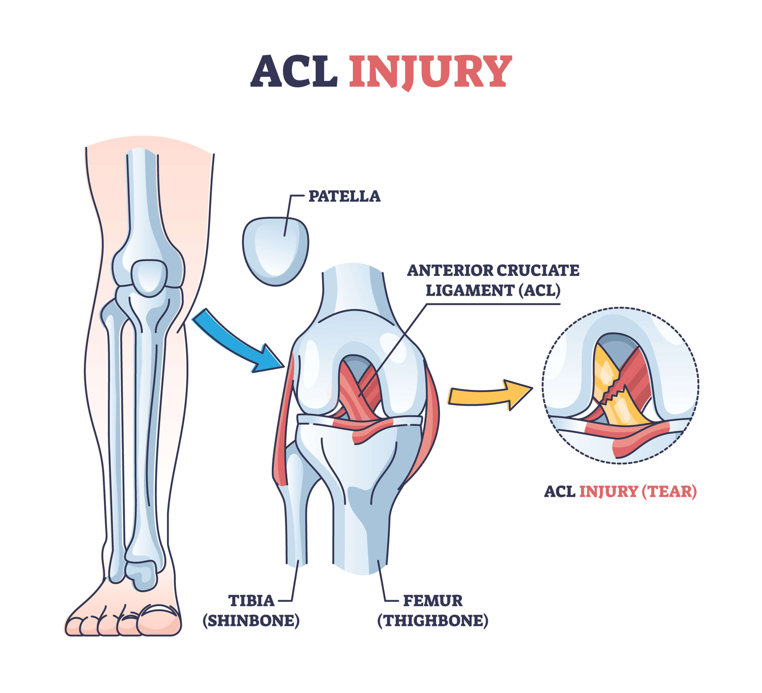 Acl Surgery: Affordable Repair Options