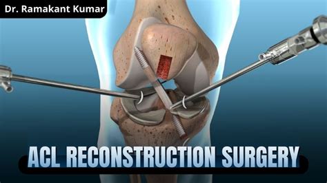Acl Surgery Cost