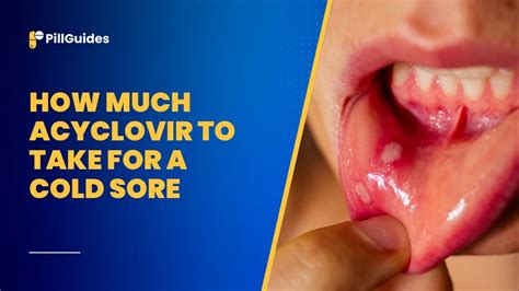 Acyclovir: Relieves Cold Sore Symptoms
