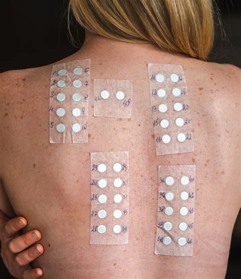 Allergy Patch Test