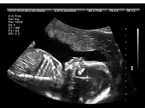 Anatomy Scan 20 Weeks