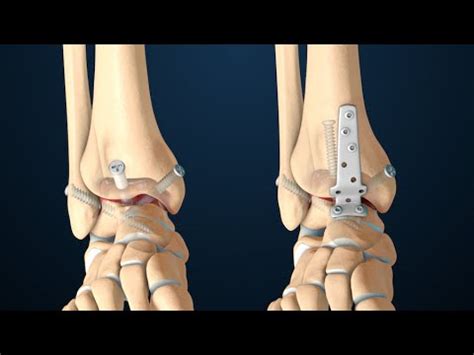 Ankle Fusion Surgery