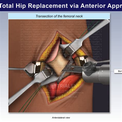 Anterior Approach Hip Replacement
