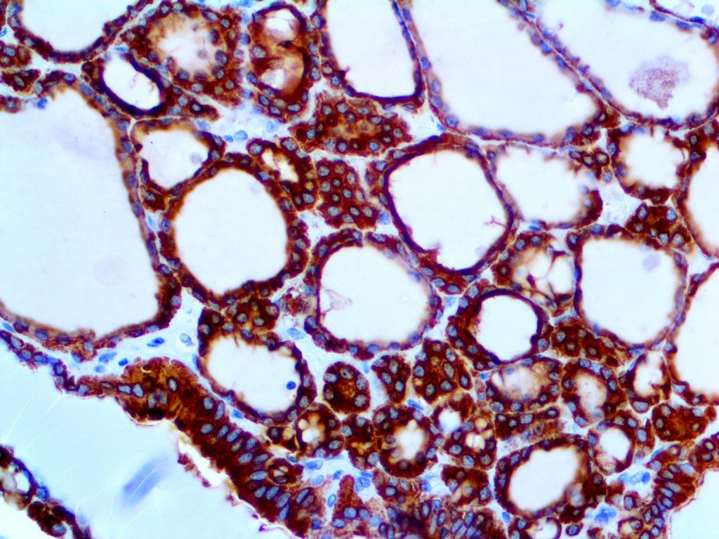 Antithyroid Peroxidase Antibody