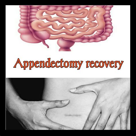 Appendectomy Recovery Fast