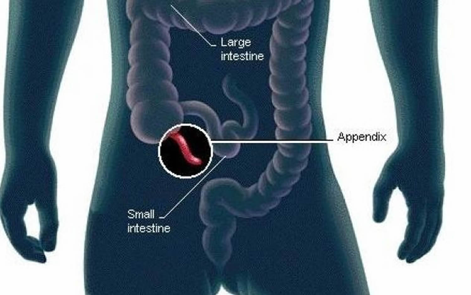 Appendix Removal Surgery: Fast Recovery Tips