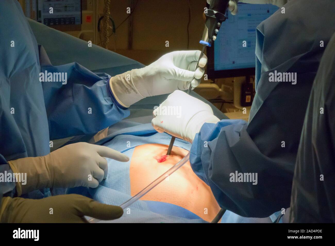 Appendix Removal Surgery