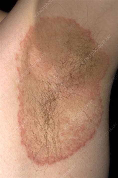 Armpit Fungus Ringworm