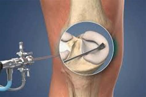 Arthroscopic Surgery Knee: Minimally Invasive Relief
