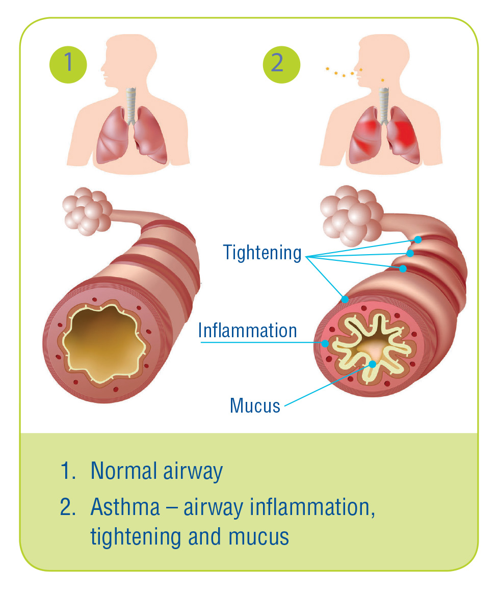 Asthma Pump With Spacer
