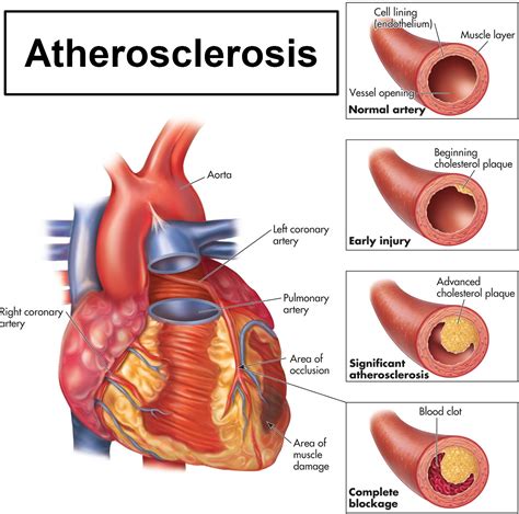 Atherosclerosis Of Aorta: Manage Risks & Improve Health
