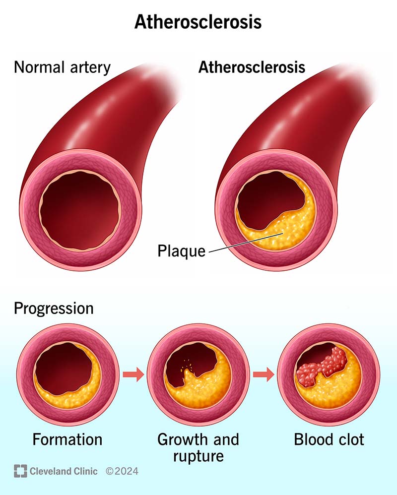 Atherosclerosis Of Aorta