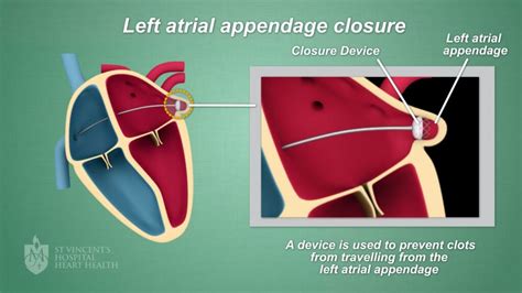 Atrial Appendage Closure: Reduce Stroke Risk