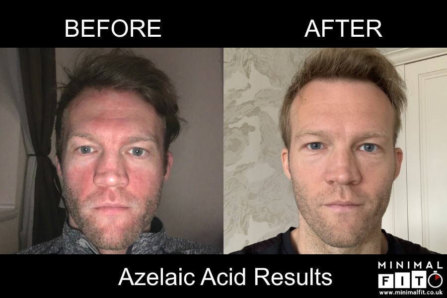 Azelaic Acid 15 Percent