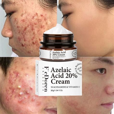 Azelaic Acid Gel: Fades Acne Scars Fast