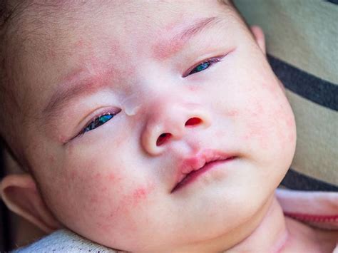 Baby Allergic Reaction